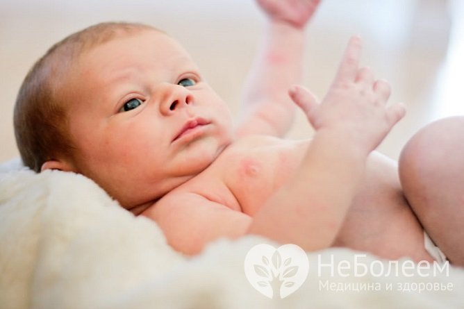 У детей первого полугода жизни при гистоплазмозе практически всегда поражаются легкие