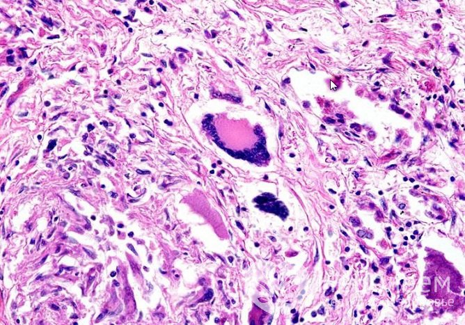 Гранулематоз Вегенера – аутоиммунное гранулематозное воспаление стенок сосудов (васкулит)