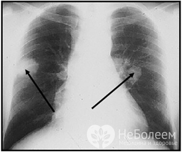 Рентгенография легких – легочные узлы при гранулематозе Вегенера