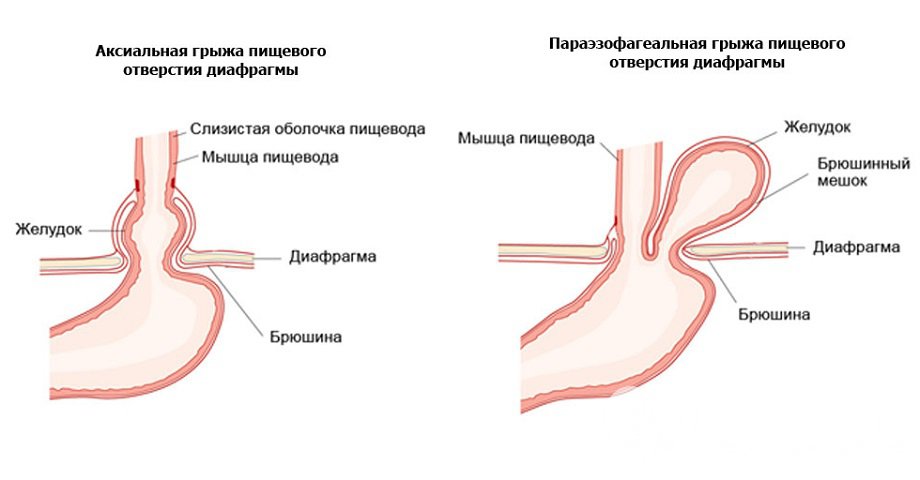 Грыжа Диафрагмы Пищевода Симптомы Лечение Диета