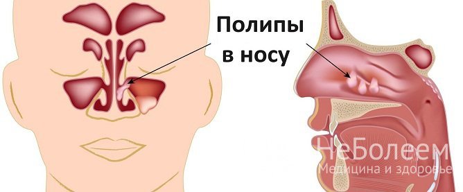 Полипы в носовой полости могут стать причиной хронизации острого гайморита