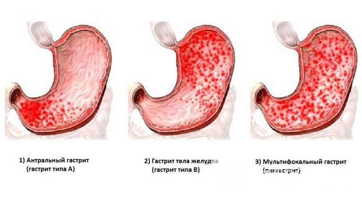 Атрофический Гастрит Симптомы И Лечение Диета