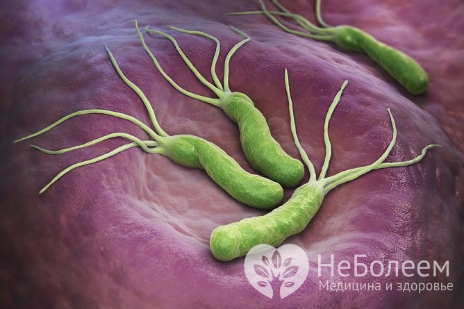 Инфицирование Helicobacter Pylori – самая распространенная причина хронического гастродуоденита