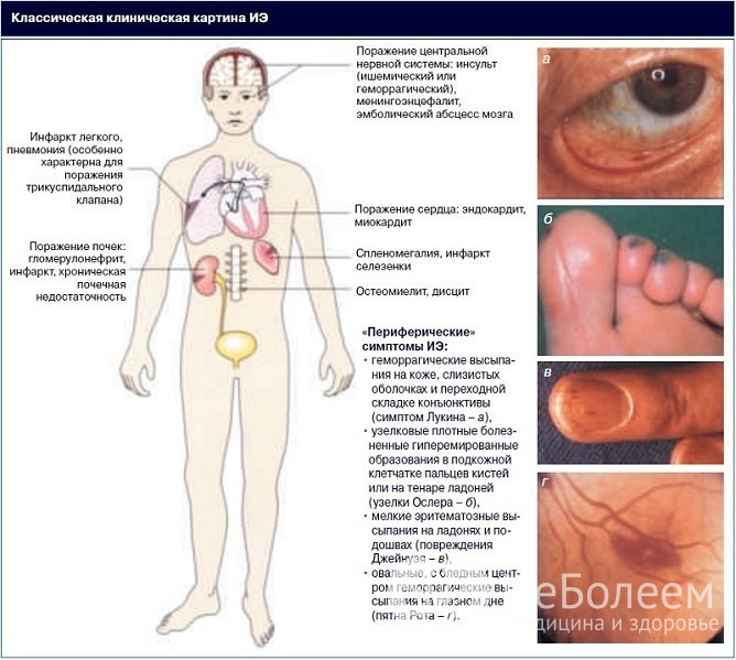 Классическая клиническая картина инфекционного эндокардита