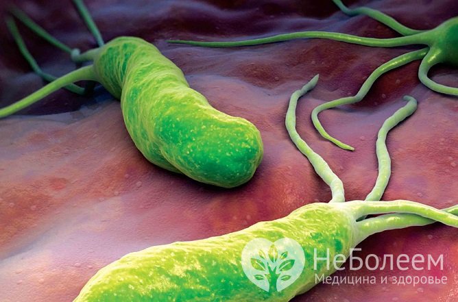 Чаще всего язвенная болезнь двенадцатиперстной кишки обусловлена бактерией Helicobacter pylori
