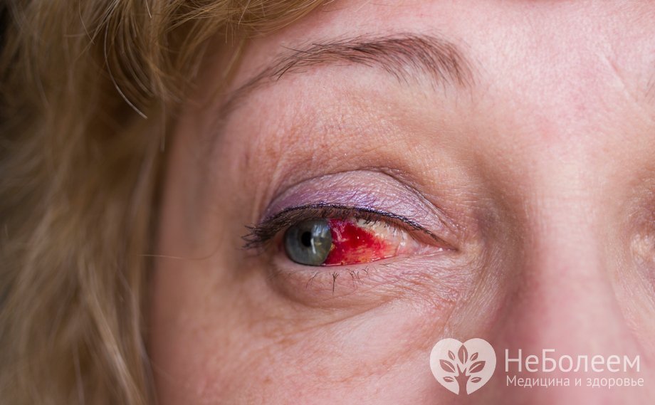 Признаки кровоизлияния в глаз