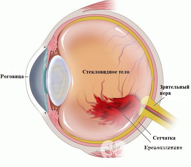 Гемофтальм или кровоизлияние глаза