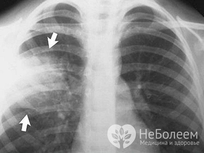 Основной метод диагностики крупозной пневмонии – рентгенография 