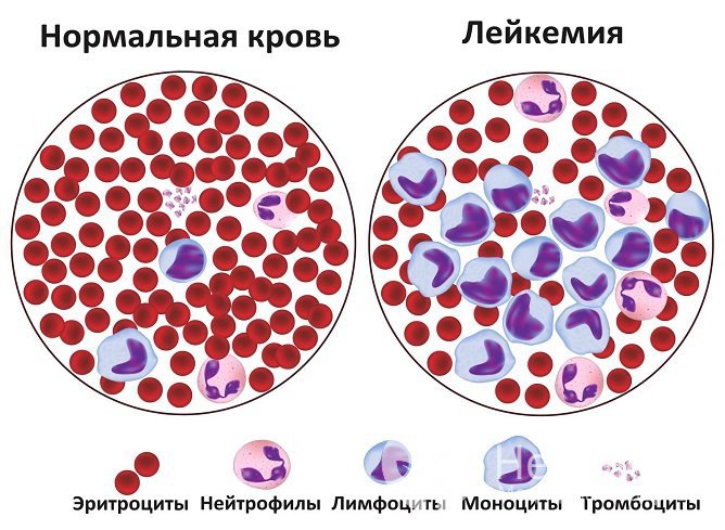 Лейкемия характеризуется бесконтрольным разрастанием незрелых клеток крови