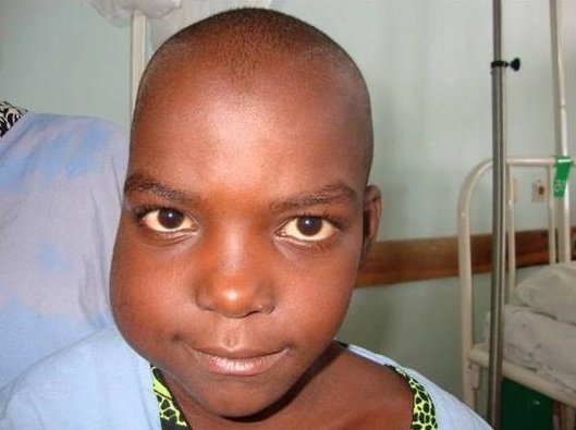 Лимфома Беркитта у детей встречается часто, особенно в Африке, на которую приходится 80% всех случаев