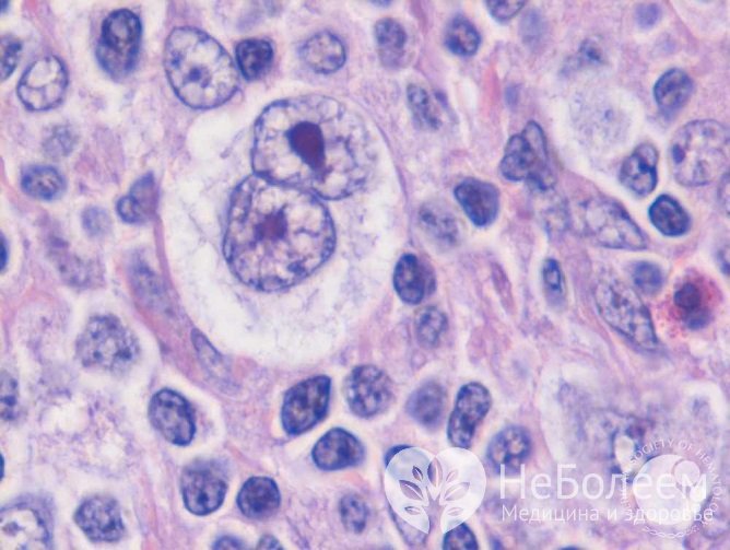 Клетки Рида – Штернберга – диагностический признак лимфомы Ходжкина