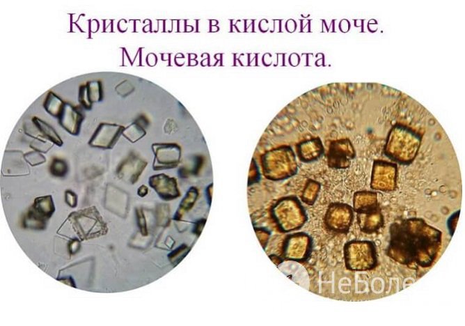 Мочекислый Диатез Симптомы У Женщин Лечение Диета