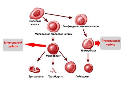 Лейкозы делятся на две основные группы: миелоидные и лимфоидные
