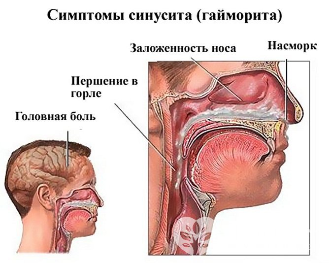 Симптомы острого синусита (гайморита)
