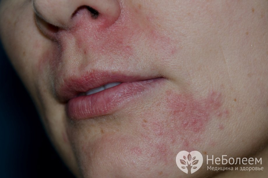 интересные способы периоральный дерматит фото на лице у женщин фото ставить