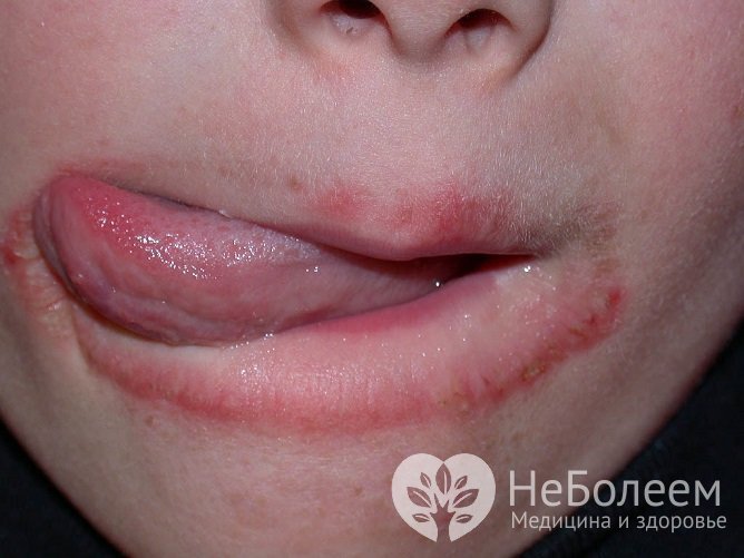 Периоральный дерматит дебютирует с возникновения вокруг рта розового пятна, напоминающего угревую сыпь