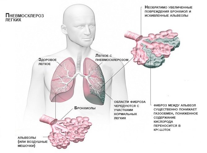Пневмосклероз легких 