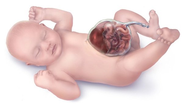 Омфалоцеле или эмбриональная пупочная грыжа – аномалия развития передней брюшной стенки