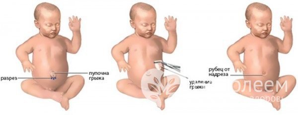 Удаление пупочной грыжи у новорожденных проводится при ущемлении, большом размере, нарушении пищеварения