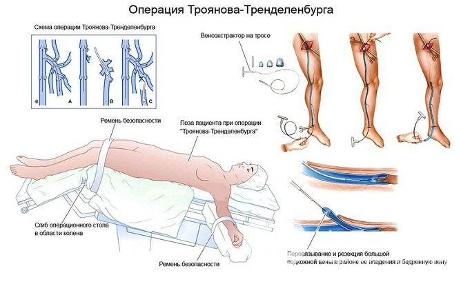 Если тромб находится в устье большой подкожной вены, выполняют операцию по Троянову – Тренделенбургу