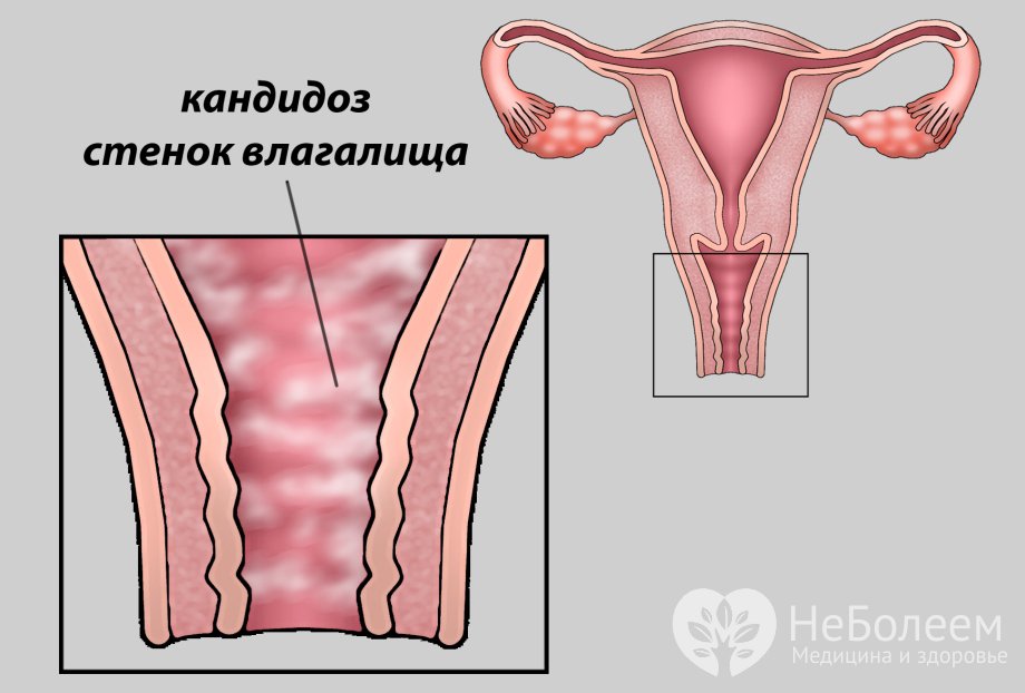 Признаки вагинального кандидоза