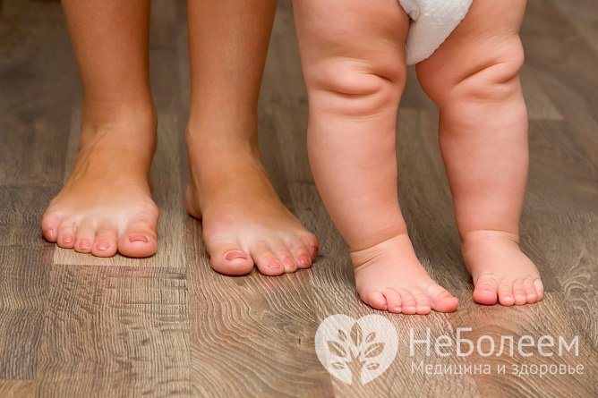 Причиной вальгусной деформации стопы у детей могут становится травмы связок и вывихи нижних конечностей