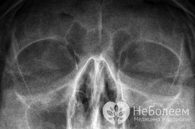 Чтобы дифференцировать вазомоторный ринит с другими патологиями ЛОР-органов, проводят рентгенографию придаточных пазух носа