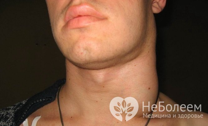 Воспаление лимфоузлов на шее при ВИЧ-инфекции