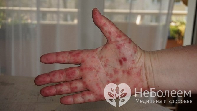 Вирус Коксаки типа А поражает преимущественно кожные покровы детей