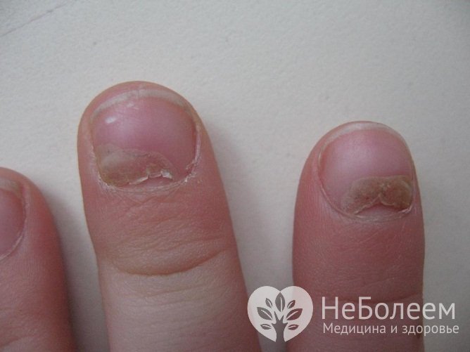 Поздним симптомом вируса Коксаки у детей является изменение ногтевых пластин