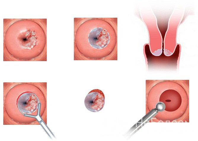 Конизация шейки матки – вид хирургического лечения при поражении шейки матки вирусом папилломы человека