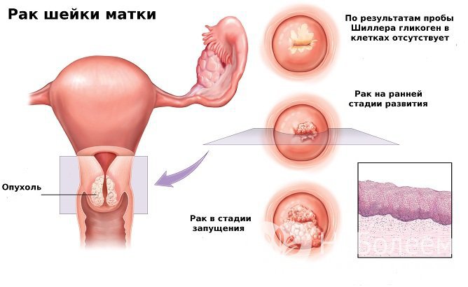 Достоверно установлена связь вируса папилломы человека с раком шейки матки