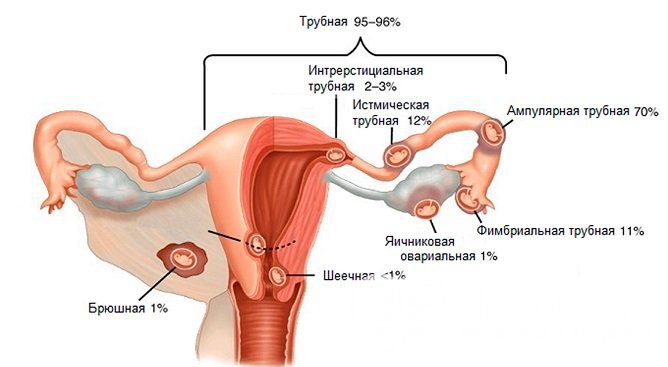 Классификация внематочной беременности