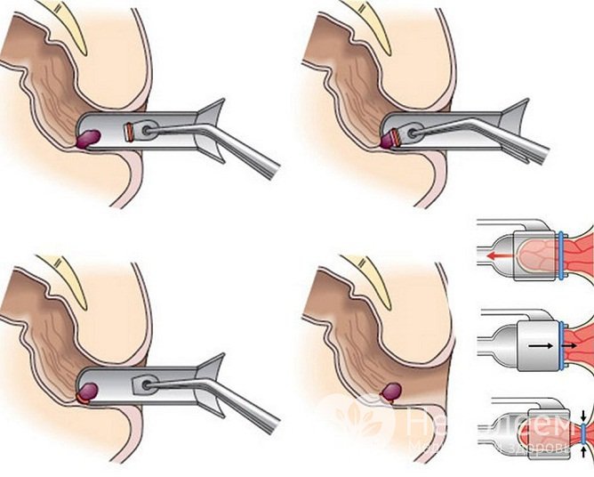 Лигирование латексными кольцами – малоинвазивный метод лечения внутреннего геморроя
