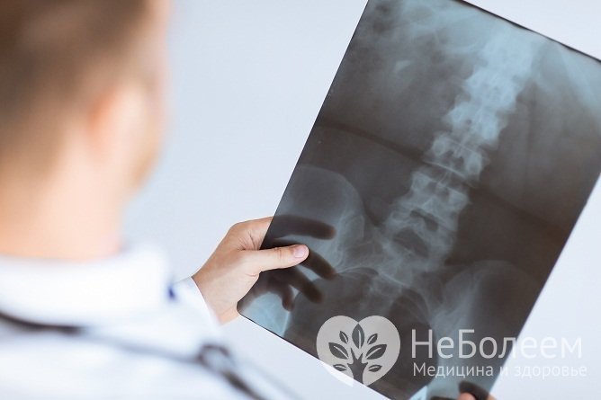 Уточнить диагноз «воспаление седалищного нерва» позволяет рентгенография пояснично-крестцового отдела