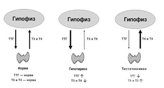 Латентный гипотиреоз характеризуется повышенным уровнем ТТГ при нормально Т4