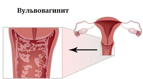 При вульвовагините воспаляются слизистые оболочки наружных половых органов