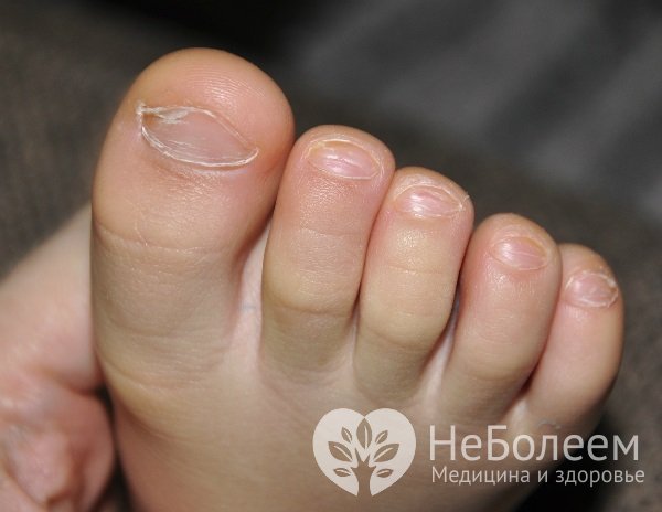 Ломкие ногти у ребенка – один из признаков железодефицитной анемии