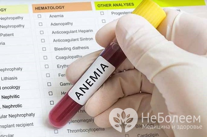 Диагноз «железодефицитная анемия» ставится на основе определения уровня гемоглобина в крови