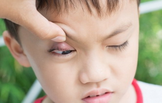 5 заблуждений о лечении ячменя на глазу