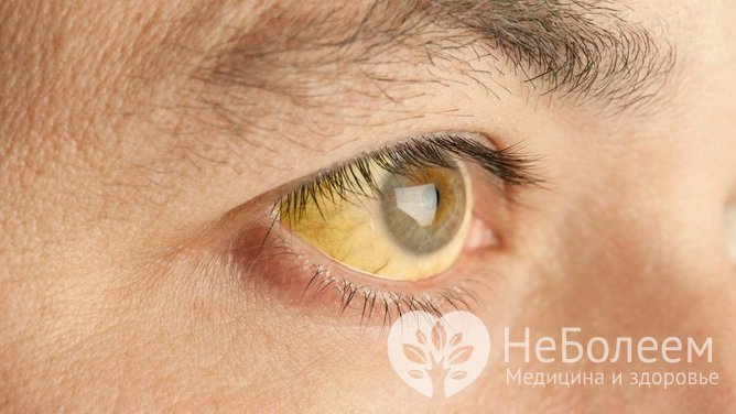 Желтый цвет белков глаз – проблема, свидетельствующая о болезни глаз