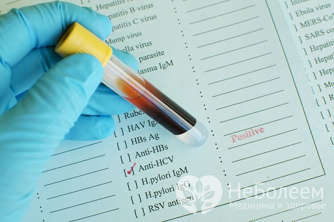 Анализ крови на гепатит С часто помогает выявить скрыто протекающее заболевание