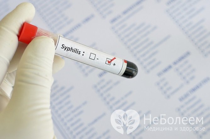 Наиболее часто в первичной диагностике сифилиса используется метод RPR – антикардиолипиновый тест