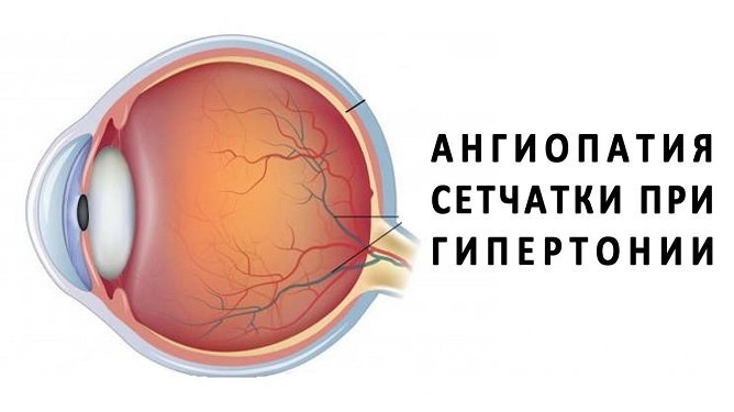 Ангиопатия сетчатой оболочки глаза – распространенное явление, особенно на продвинутых стадиях гипертонии