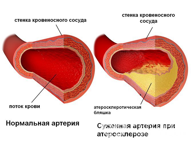 Атеросклероз - один из факторов, способствующих артериальной гипертензией.