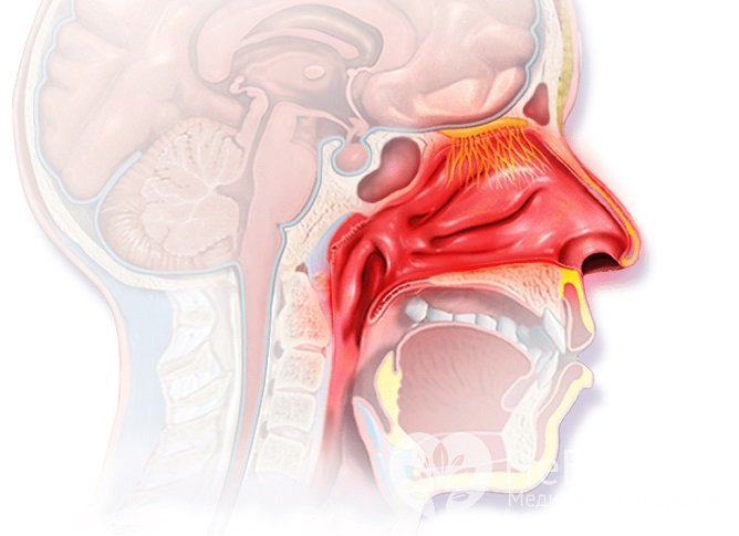 Гипертрофический насморк характеризуется утолщением слизистых тканей носа