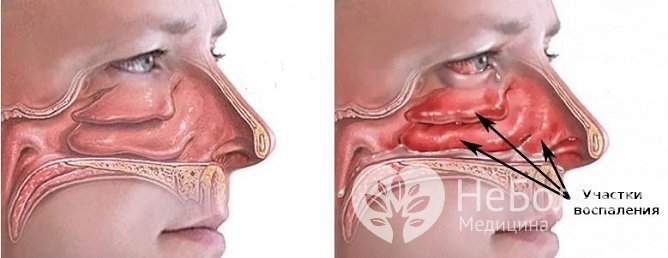 Вазомоторный ринит характеризуется заложенностью носа и затруднением носового дыхания
