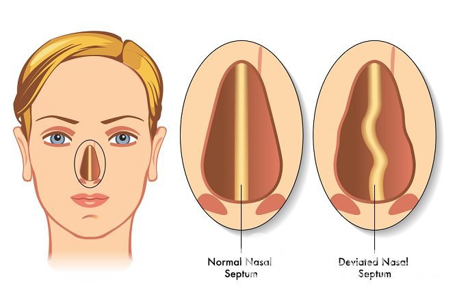 К развитию болезни может привести искривление носовой перегородки