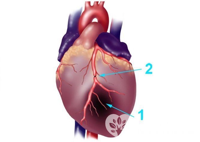 Причиной инфаркта становится прекращение кровотока по коронарной артерии