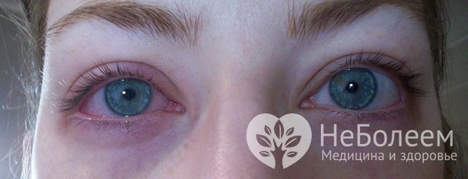 При аллергии кашель сопровождается часто слезотечением, прозрачными выделениями из носа, кожным зудом